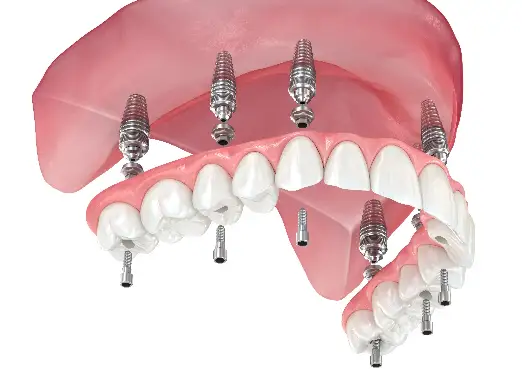 Dental Implant Restoration