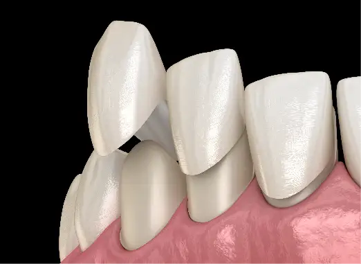 Dental Crowns & Bridges